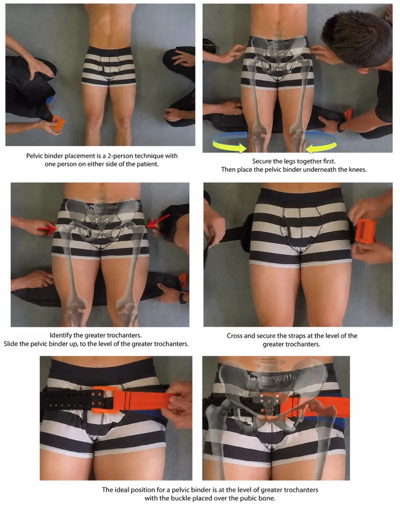Pelvic binder application steps with anatomical overlay