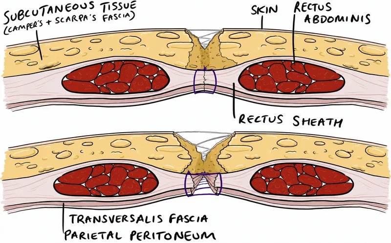 Abdominal wall layers and wound dehiscence