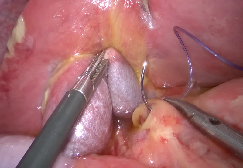 Laparoscopic Graham patch repair
