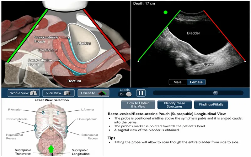 eFAST Suprapubic Longitudinal View Diagram