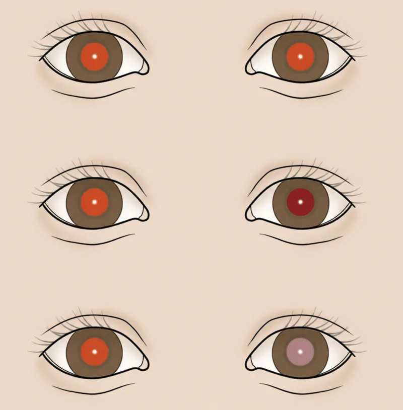 Bruckner test showing asymmetric red reflex
