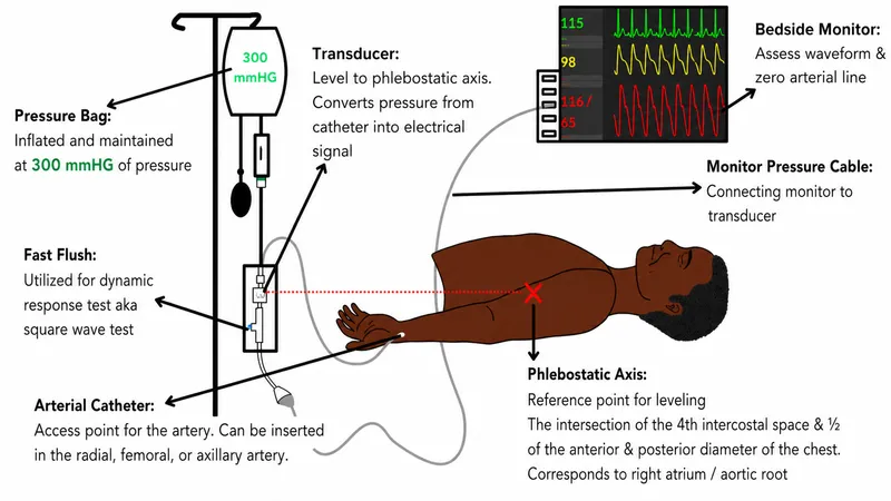 ICU hemodynamic monitoring setup with arterial line and central venous catheter