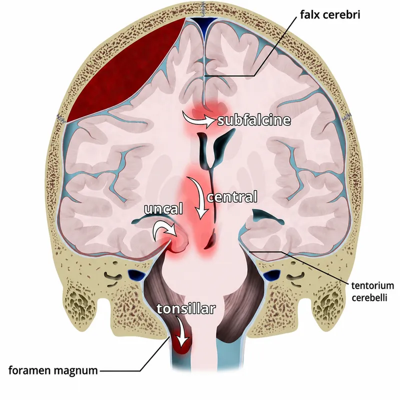 Brain herniation types