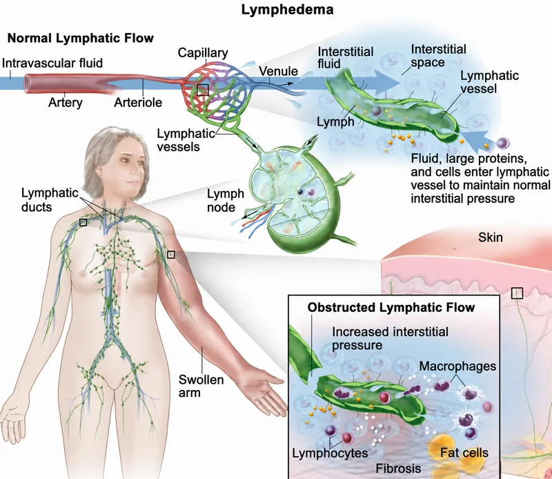 Lymphedema: Normal vs. Obstructed Lymphatic Flow