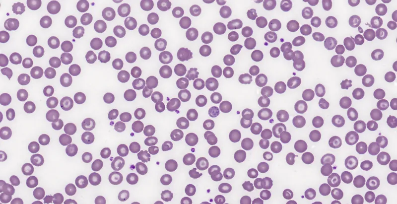 Peripheral blood smear: Howell-Jolly bodies, target cells