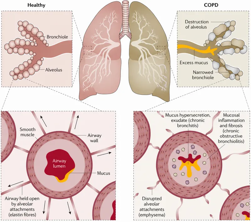 COPD: Emphysema vs. Chronic Bronchitis Airway Changes