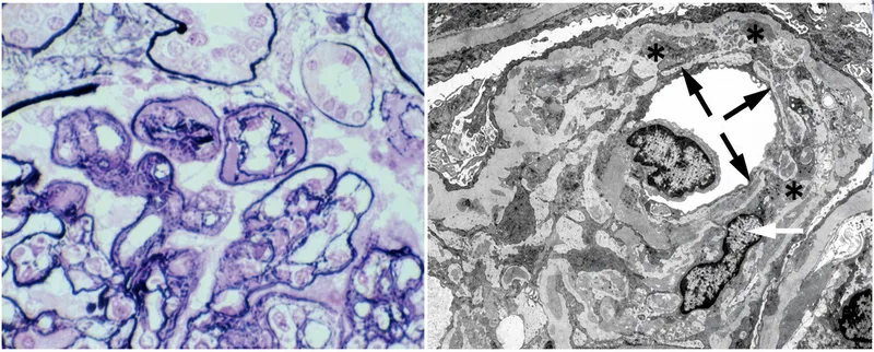 MPGN tram-track appearance (light and electron microscopy)