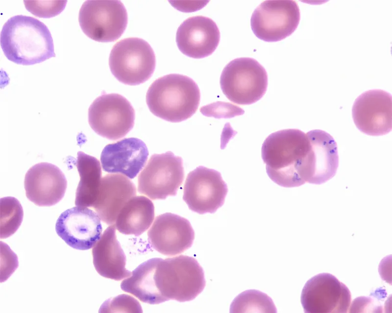 Basophilic stippling in lead poisoning