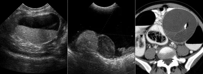 Ovarian dermoid cyst ultrasound and CT