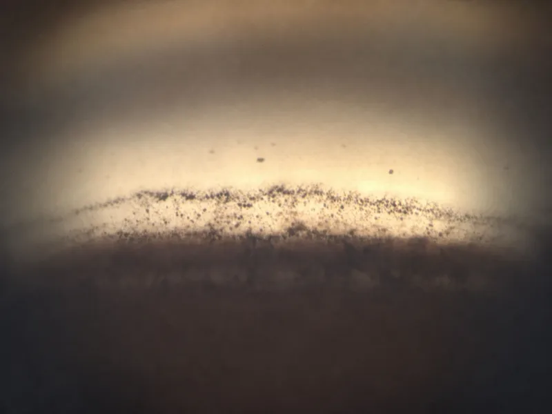 Gonioscopy of pigment dispersion in trabecular meshwork