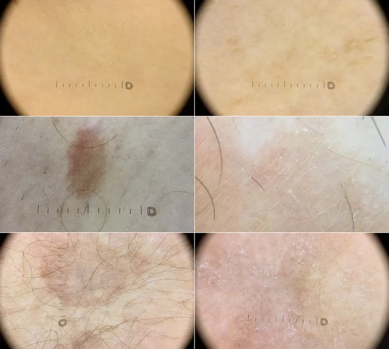 Dermoscopy of Pityriasis Alba vs Tinea Versicolor