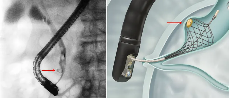 ERCP stone extraction for choledocholithiasis