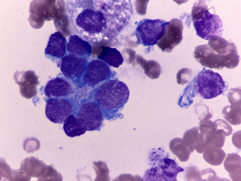 Neuroblastoma metastases in bone marrow showing Homer Wright rosettes