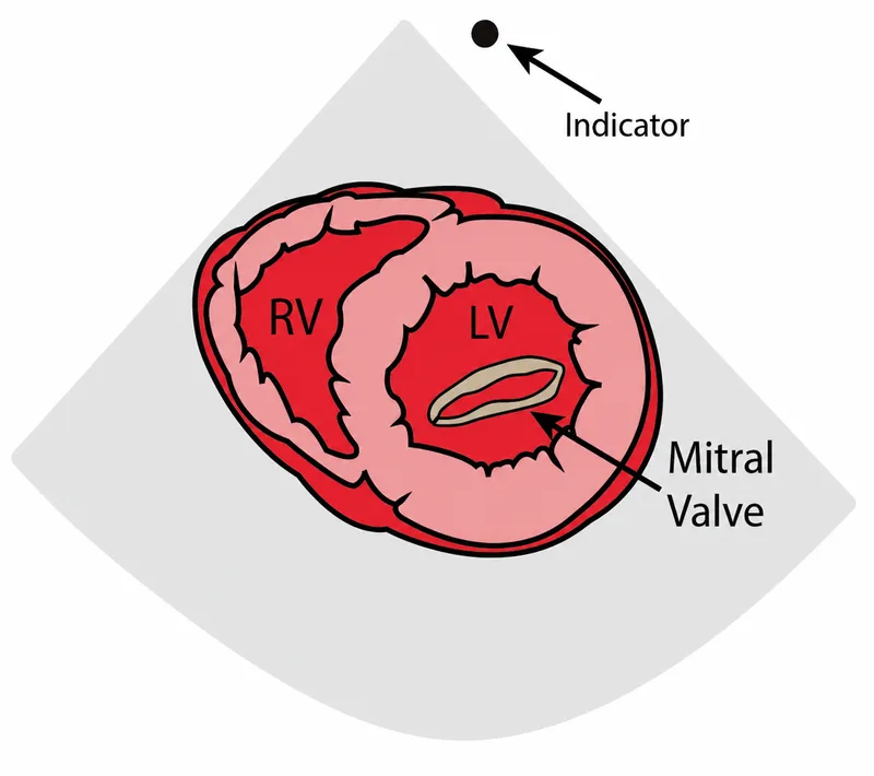 PSAX Mitral Valve Level ("Fish Mouth" View)