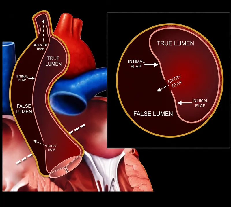 Aortic dissection: true and false lumens