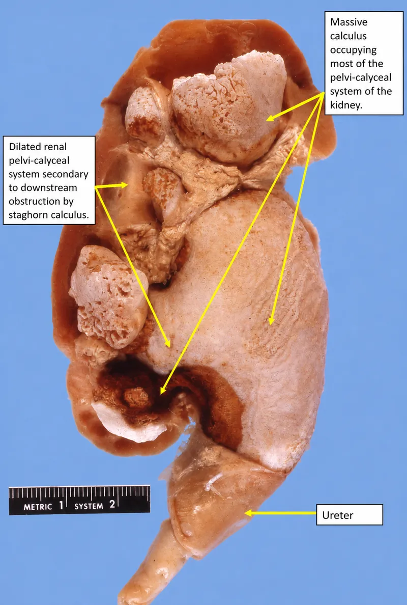 Kidney with staghorn calculus and dilated renal pelvis