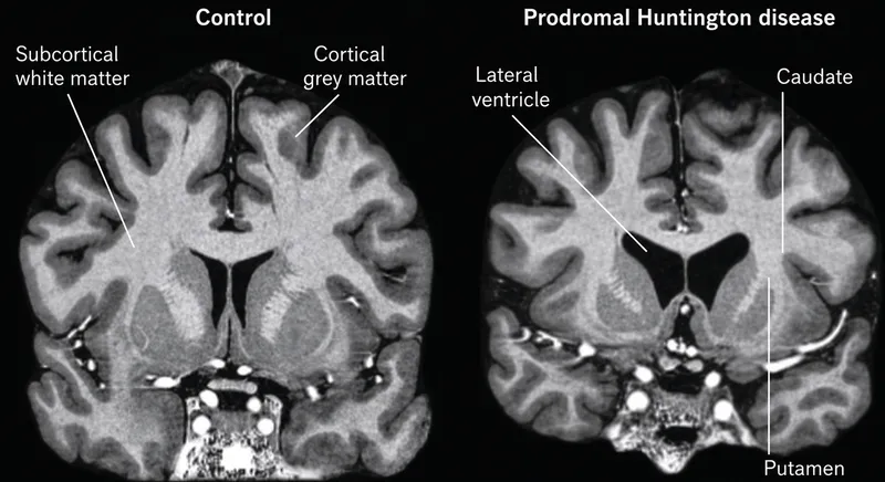 MRI showing caudate atrophy in prodromal Huntington's