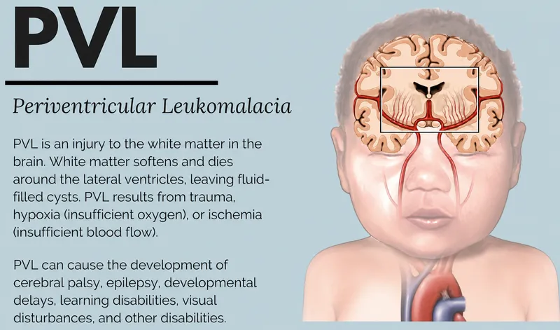 Periventricular Leukomalacia (PVL) and its effects