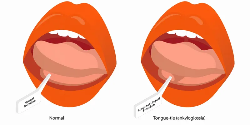 Normal vs. Tongue-tie (Ankyloglossia)