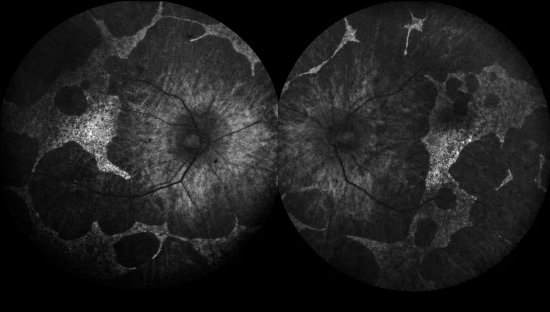 Fundus autofluorescence in Gyrate Atrophy
