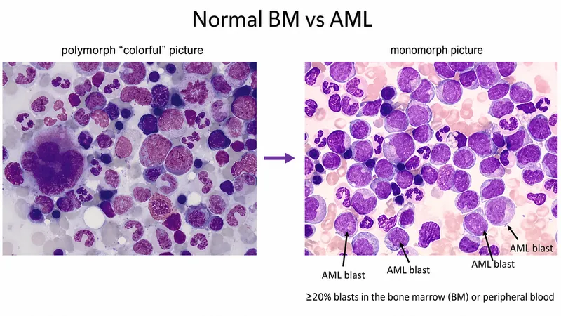 Normal vs AML bone marrow with increased blasts