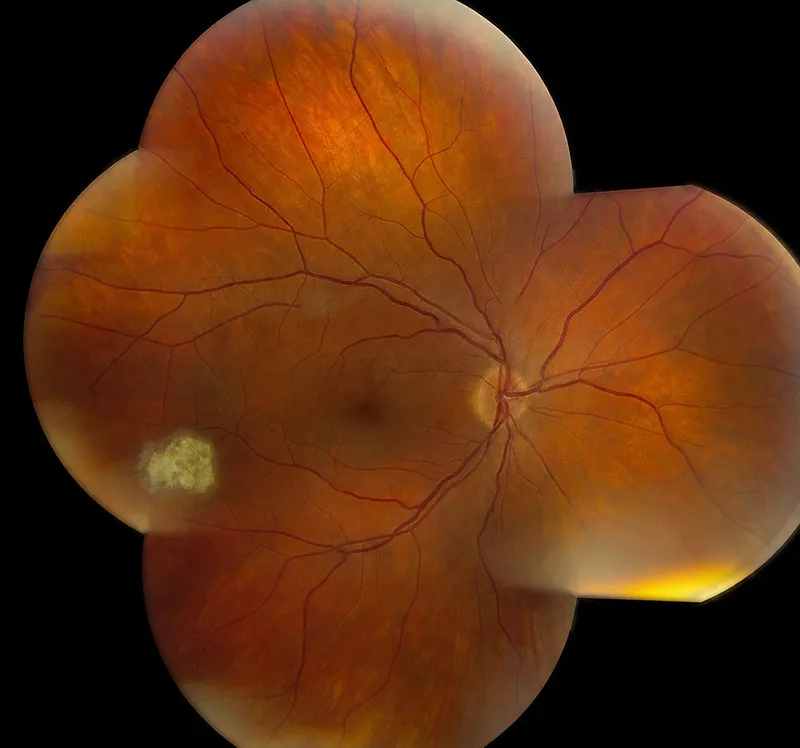 Astrocytic hamartoma (mulberry lesion)
