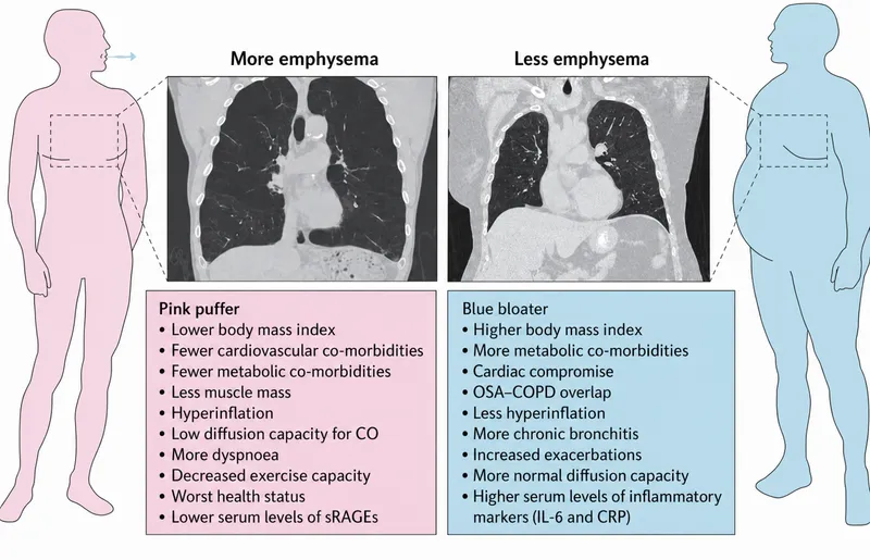 Pink Puffer vs. Blue Bloater COPD Phenotypes