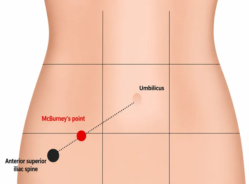 McBurney's point location