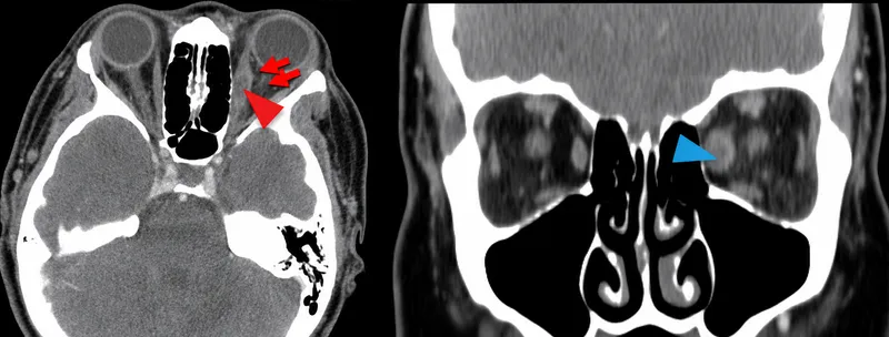 Idiopathic orbital inflammation with muscle thickening