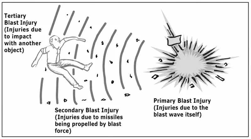 Primary, secondary, and tertiary blast injury mechanisms