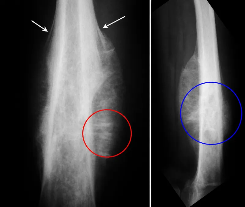 Ewing Sarcoma X-ray with Onion Peel Appearance