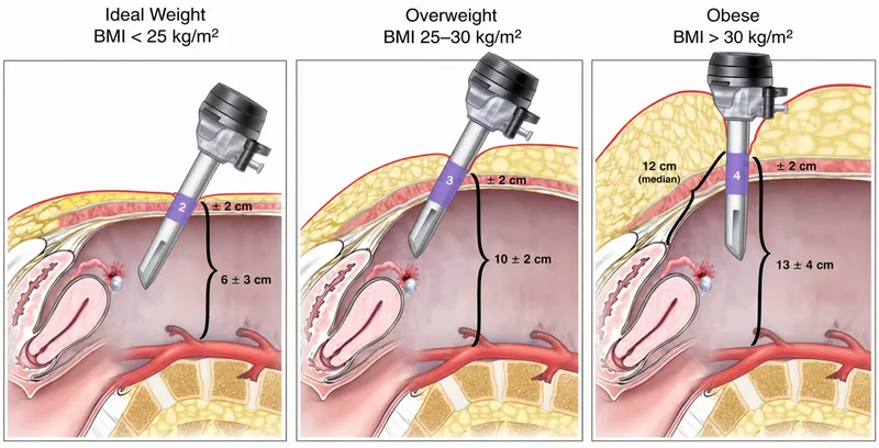 Laparoscopic port depth by BMI