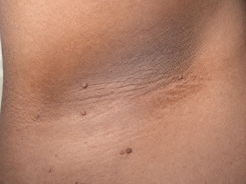 Acanthosis nigricans in axilla