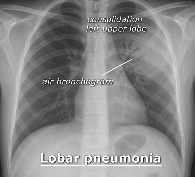 Pediatric chest X-ray: Lobar pneumonia, left upper lobe