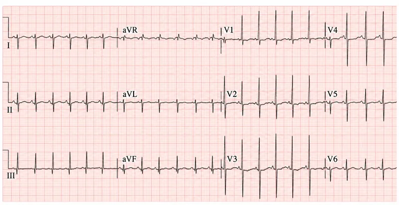 ECG of two-day-old infant with normal findings