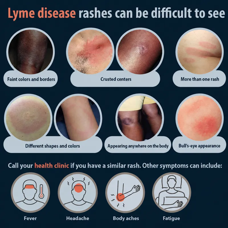Varied presentations of Lyme disease rashes