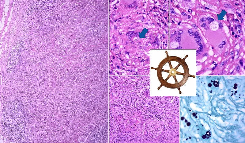 Paracoccidioides brasiliensis: Pilot's wheel yeast forms