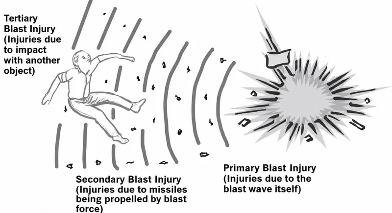Primary, secondary, and tertiary blast injury mechanisms