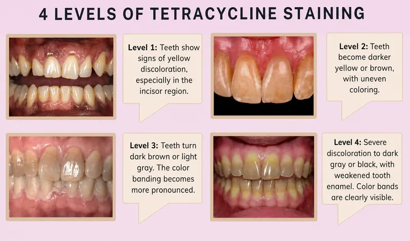 Tetracycline Staining Levels on Teeth