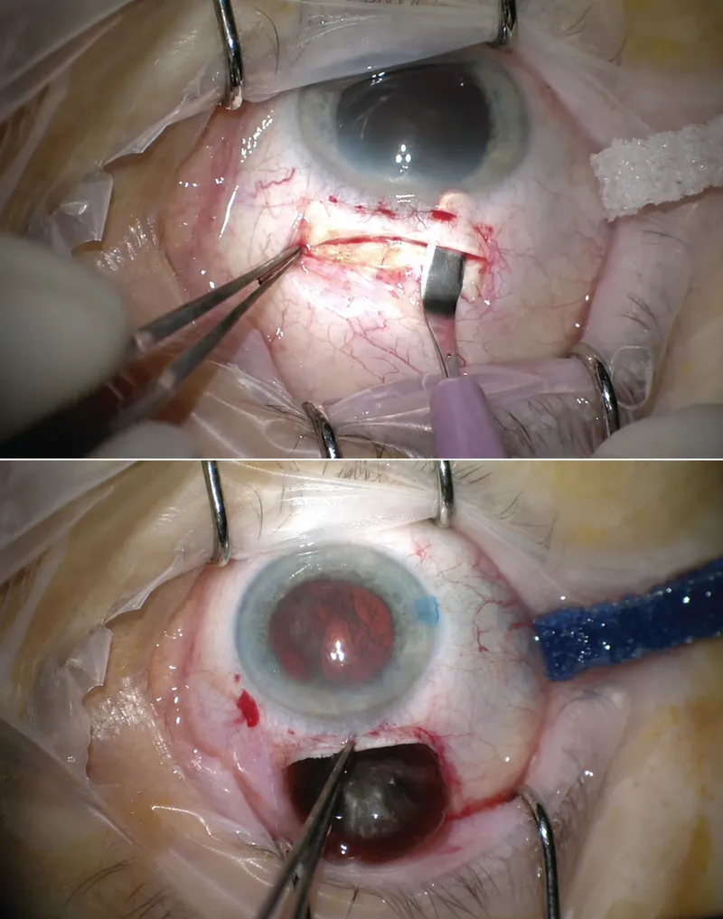 SICS steps: scleral tunnel and nucleus delivery