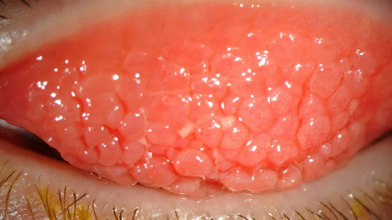 Giant Papillary Conjunctivitis cobblestone papillae