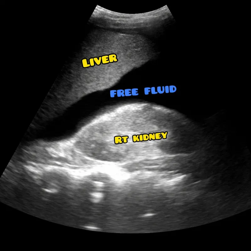 FAST exam: Free fluid in Morison's pouch