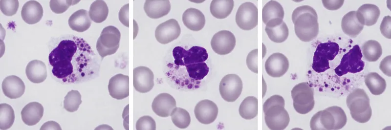 Chediak-Higashi syndrome giant granules