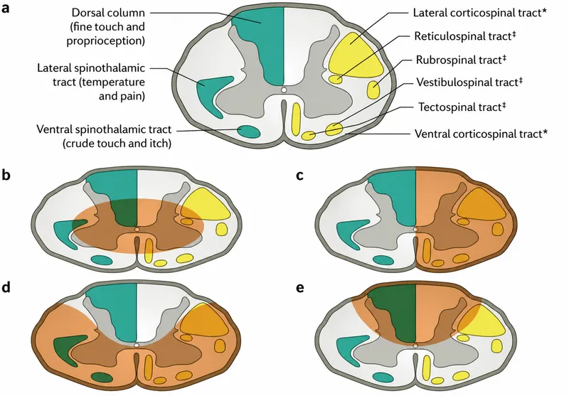 Spinal cord cross-section with tracts and injury patterns