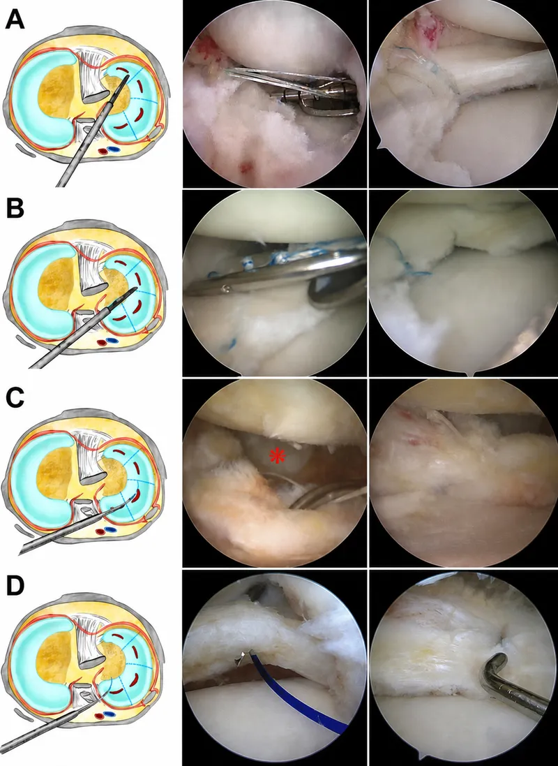 Knee arthroscopy: portals, instruments, and procedures
