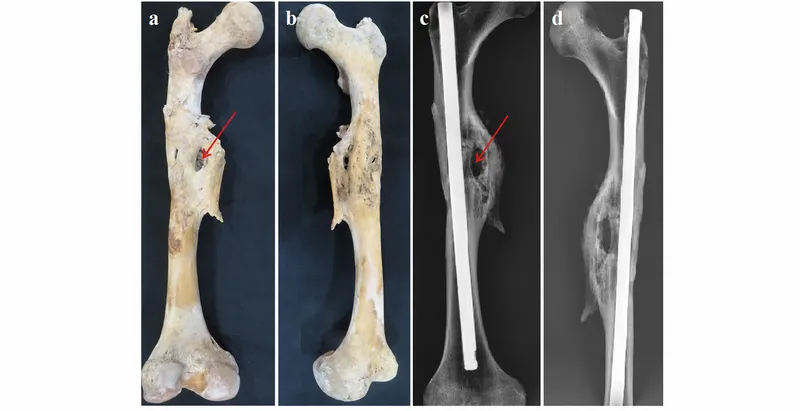 Postmortem femur with orthopedic implant