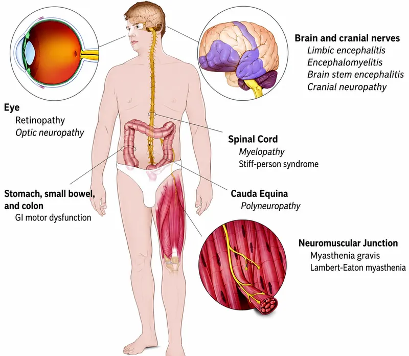 Neurological manifestations of autoimmune diseases